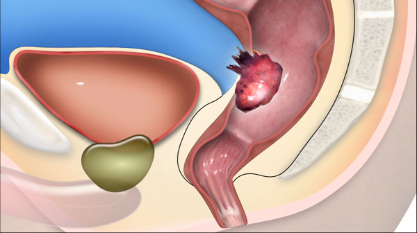 Rectal Cancer  MR staging and restaging- update 2026