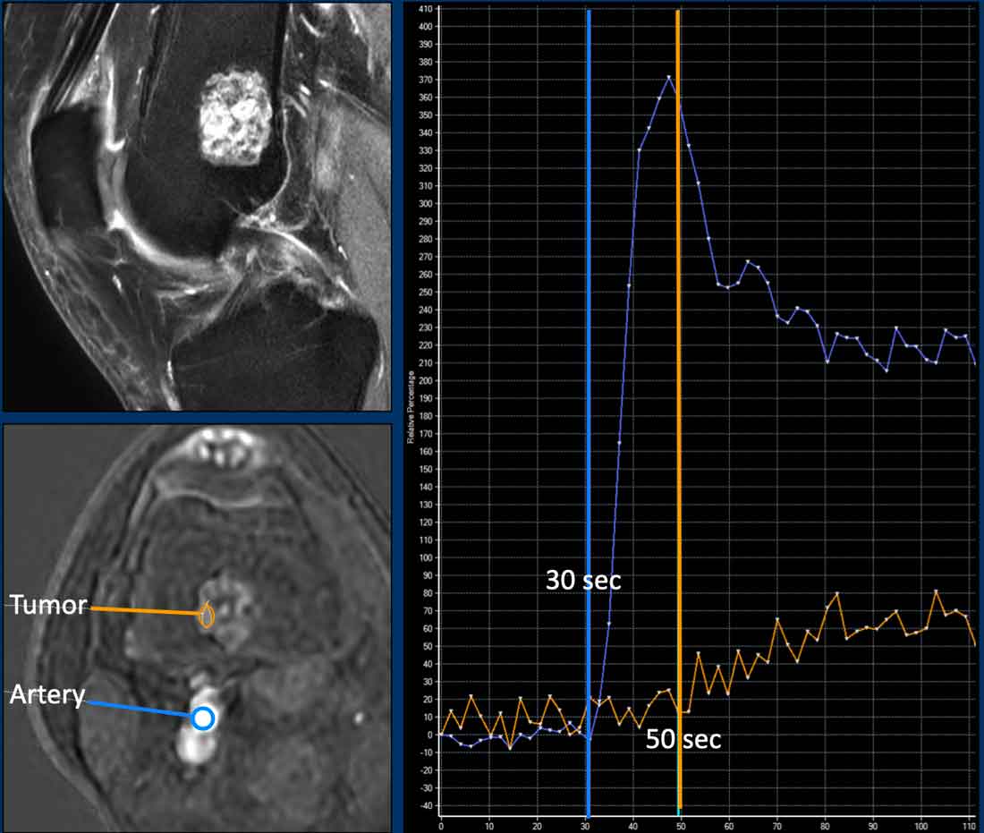 ACT along the posterior cortex in the distal femur showing septonodular enhancement after contrast. Two ROIs were placed, one in the tumor (orange) and one in the popliteal artery (blue).