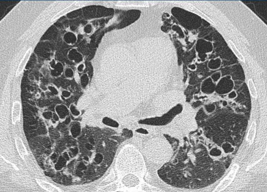 Williams-Campbell syndrome with widespread bronchiectasis