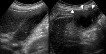 Longitudinal and transverse US show thickened gallbladder wall. The gallbladder is noncompressible ('hydropic') and causes an impression in the anterior abdominal wall (arrowheads).