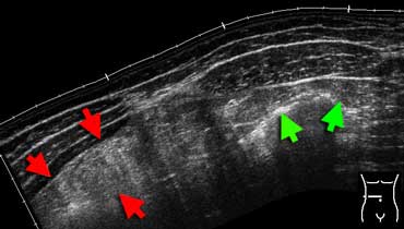 Inflamed fat at sonography. Extended-view of the ventral abdomen depicting an area of hyperechoic noncompressible inflamed fat in the omentum (red arrows). Compare this to the echogenicity of normal abdominal or subcutaneous fat (green arrows). This patient had an omental infarction.