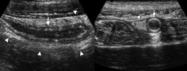 Fig. 3. A 19 year old woman with appendicitis. Longitudinal and transverse sonogram show an enlarged appendix (arrows) surrounded by hyperechoic inflamed fat (arrowheads).