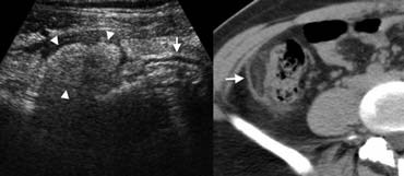 Fig. 7.- 29-year-old woman with epiploic appendagitis. A, Sonography of the right lower quadrant reveals a hyperechoic inflamed fatty mass (arrowheads) adjacent to the colon (arrow), at the spot of maximum tenderness. B, On unenhanced CT the fatty lesion contains a characteristic hyperattenuating ring (arrow) corresponding to thickened visceral peritoneal lining.
