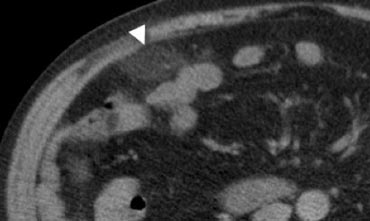 Fig. 9.- 47-year-old woman with acute right lower quadrant pain. Unenhanced CT shows an ovoid inflamed fatty mass (arrowhead) with normal regional bowel loops. The shape and size of the lesion suggests epiploic appendagitis, but the lesion does not contain a hyperattenuating ring. In this case, it is difficult to discriminate between epiploic appendagitis or a small omental infarction.