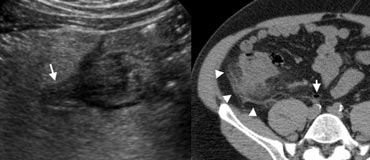 Fig. 10.- 51-year-old man with right-sided colonic diverticulitis. A, Unenhanced CT shows extensive with fat-standing along the cecal wall (arrowheads), and a normal appendix (arrow). B, Sonography reveals the cause of the inflammation by depicting an inflamed cecal diverticulum (arrow) centred in the hyperechoic fat.