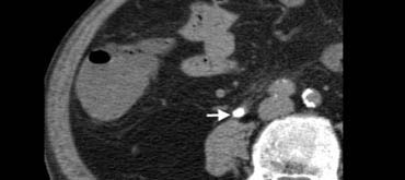 Fig. 13. 77-year-old man with a right ureteral stone.Unenhanced CT shows an obstructing calcification (arrow) within the distal ureteral lumen.
