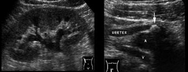 Fig. 14. 40-year-old woman with a ureteral stone.A and B, Sonography shows right-sided hydronephrosis (A), and an obstructing calculus (B, arrow) in the distal ureter at the level of the iliac vessels.