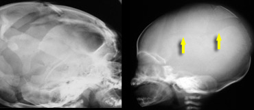 LEFT: eggshell fractures in a child who died of cerebral injury after being thrown from a height. RIGHT: skull fracture in abused child
