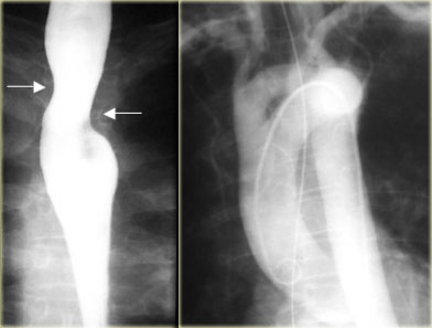 Double ArchLEFT: Right and left arch indent esophagus (arrows) at different levels RIGHT: Angiogram with double arch in asymptomatic 65-year-old