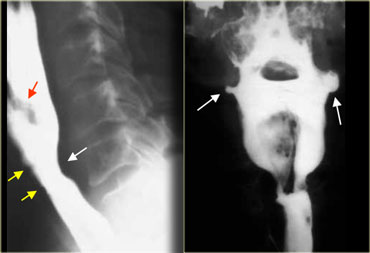 LEFT: Lateral view: Epiglottis (red arrow). Post cricoid impression (yellow arrows). Cricopharyngeous impression (white arrow).RIGHT: AP-view: Small lateral pharyngeal pouches (arrows)