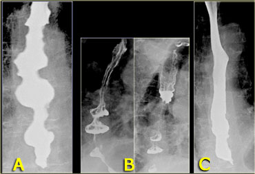 A. Initial nonpropulsive tertiary contractions B. Three images during examination show collections resembling diverticula C. Image later in examination shows resolution of tertiary contractions