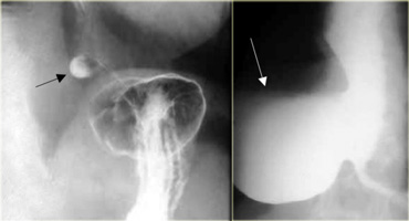 LEFT: Small diverticulum (arrow) in asymptomatic patient RIGHT: Large diverticulum (arrow) in patient with aspiration