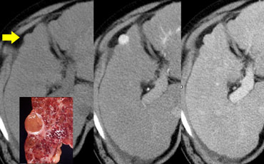 Small Hepatocellular carcinoma in cirrhotic liver not visible on NECT (left), clearly visible in arterial phase (middle) and not visible in portal venous phase (right)