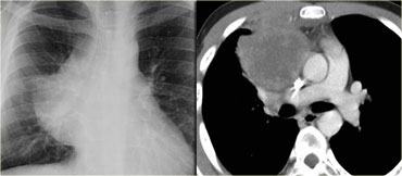 Hilum Overlay Sign: hilar vessels are seen through a mediastinal mass