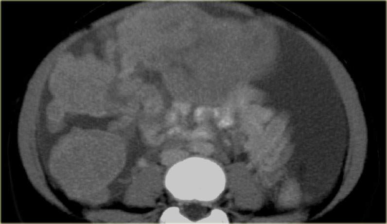 Desmoplastic Small Round Cell Tumor