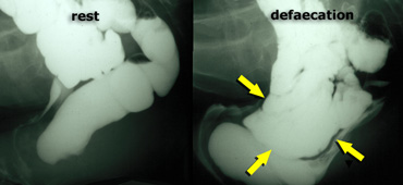 Normal findings at rest (left); during defecation there is a rectocele, that is pushed downward by an enterocele .