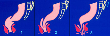 1 : Intra-rectal intussusception, 2 : Intra-anal intussusception, 3 : Extra-anal intussusception (rectal prolapse)
