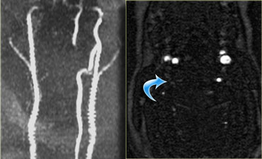 Right vertebral artery thrombosis