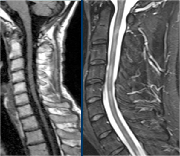 Atrophy in longstanding MS