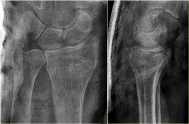 Good alignment after closed recuction for extraarticular Colles fracture