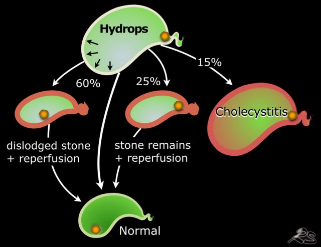 Follow up in 100 patients presenting with acute hydrops at the ER treated with spasmolytics and not immediately operated. In 15 acute cholecystitis developed. In 25 the stone remained in place, but bile can pass and hydrops disappears. In 60 patients the stone becomes dislodged and the galbladder returns to normal sometimes with a period of reperfusion edema.
