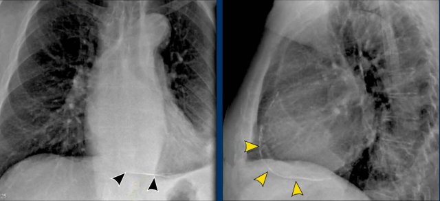 Pericardial calcifications associated with constrictive pericarditis.
