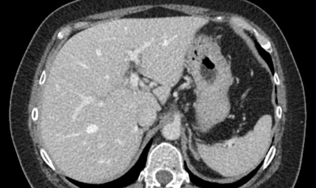 Portal venous phase