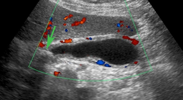 US performed 5 hours after the pain episode. There is both reperfusion edema and hyperemia of the gallbladder wall. The obstructing stone (arrow) is still visible in the neck, but there was no hydrops