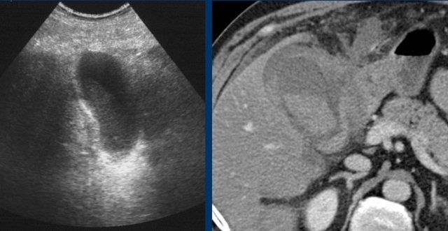 Hemorrhagic cholecystitis. US only shows a sludge-like mass. CT scan demonstrates hyperdense blood within the lumen and an irregular wall. Cholecystectomy was technically very difficult.
