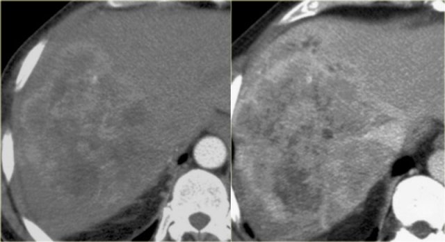 Early and late phase enhancement of a intrahepatic cholangiocarcinoma