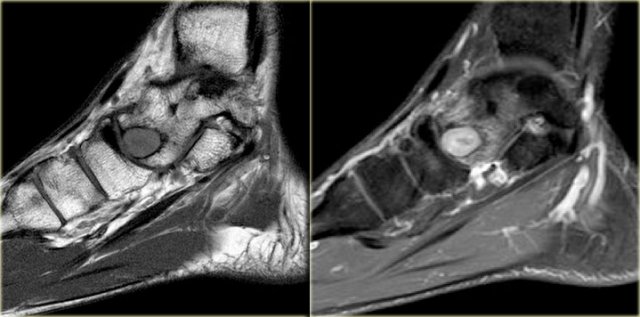 Chondroblastoma. Sagittal T1-weighted image (left) and sagittal T1-weighted image with fatsat after Gd-DTPA (right).