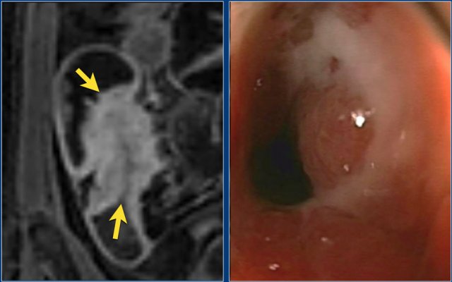 Coronal post-contrast T1 image with a stenosis at the ileocecal junction (left). No obvious pre-stenotic dilatation is seen. The stenosis was non-passable using endoscopy (right).