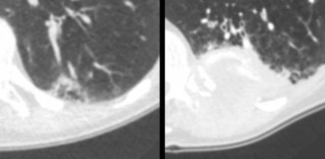 Multiloculated cystic lesion (left panel) interpreted as “non-specific”, despite a 6-month follow-up CT (for another reason) showed mild increase of ground glass, cystic air spaces and overall lesion size. The next CT was obtained for chest pain 2 years later, showing a large mass invading the chest wall (right panel). Patient died from metastatic lung adenocarcinoma.