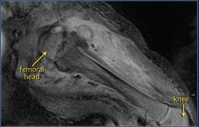5 week old, sick infant with severe osteomyelitis of the left hip. MRI with Gadolinium contrast shows extensive soft tissue involvement and periosteal reaction.