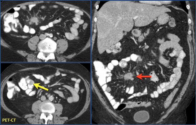 Small intraluminal mass in the ileum (yellow arrow). Associated spiculated mesenteric mass with adjacent desmoplastic reaction in small bowel carcinoid.
