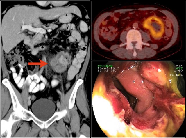 EATL lymphoma in a patient with celiac disease.